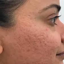 Open Pores Treatment.jpg